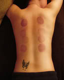 Cupping marks on a persons back